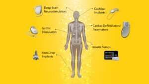 Figure 1: Implantable medical devices are used across a wide range of disorders. This includes deep brain stimulators to treat Parkison’s, Cochlear implants to treat hearing loss, gastric stimulators to treat gastroparesis, pacemakers to treat heart failure, insulin pumps to treat Diabetes, and foot drop implants to treat gait impairments5
